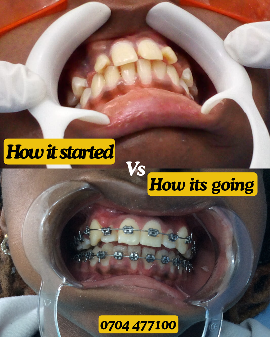 Braces transformation 2b